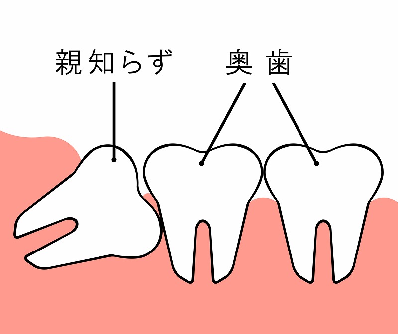 健康な歯を抜かずに済む 